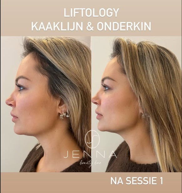 Liftolofy +Lipo pakket gelaat 3 zones ( 3 sessies) start 12/05/2025 €900 i.p.v. €1200