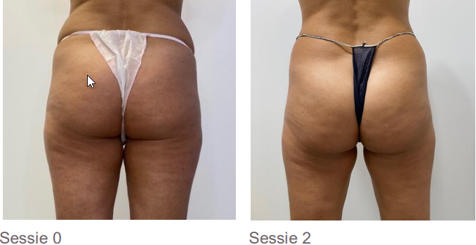 Voucher BodyShock behandeling 10 behandelingen + 30% korting op de BodyShock producten