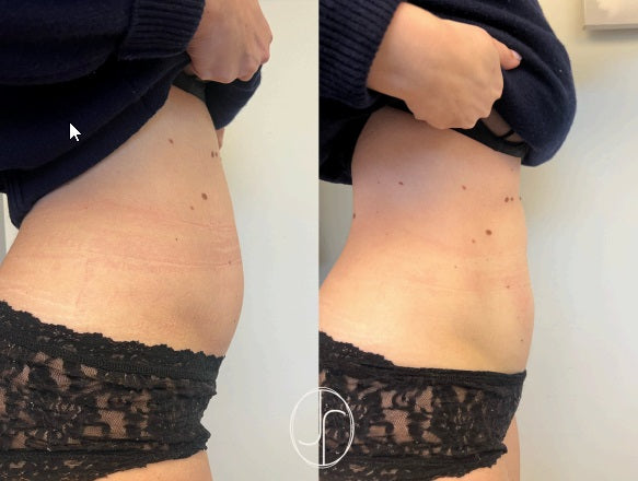 Liftolofy +Lipo pakket onderbuik of bovenbuik ( 3 sessies) start 12/05/2025 €1200 i.p.v. €1500
