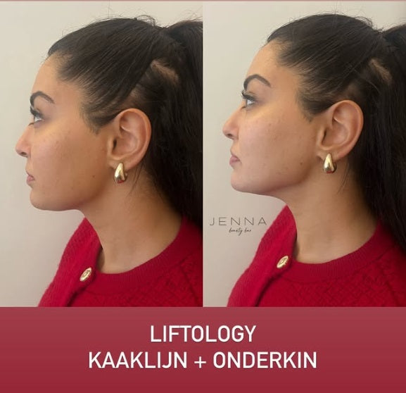 Liftolofy +Lipo pakket gelaat 3 zones ( 3 sessies) start 12/05/2025 €900 i.p.v. €1200