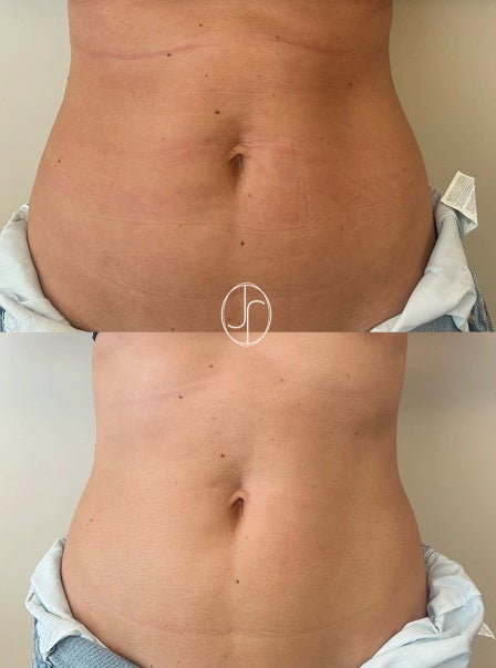 Liftolofy +Lipo pakket onderbuik of bovenbuik  ( 3 sessies) start 12/05/2025 €1200 i.p.v. €1500