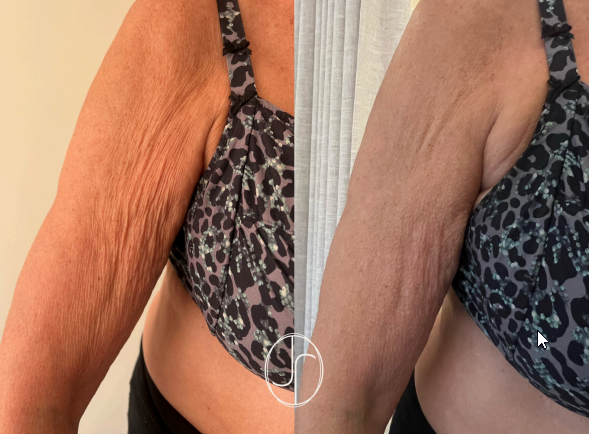 Liftolofy +Lipo pakket Bovenarmen  ( 3 sessies) start 12/05/2025 €900i.p.v. €1200