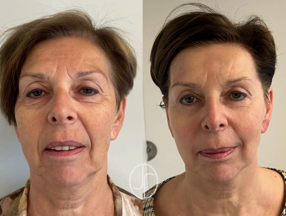 Liftolofy +Lipo pakket full face lift  ( 3 sessies) start 12/05/2025 €1650 i.p.v. €1950